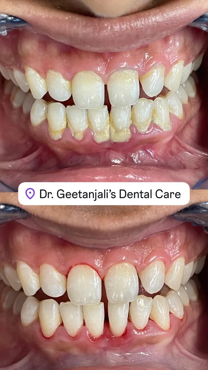 Professional scaling and polishing — before and after