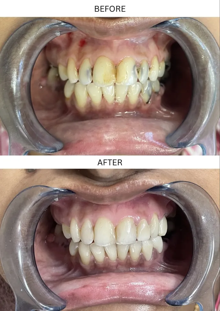 Smile makeover — before and after