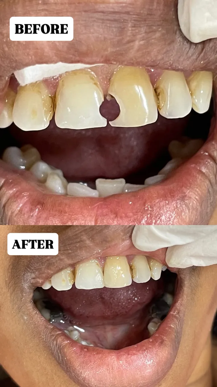 Tooth-coloured composite filling — before and after