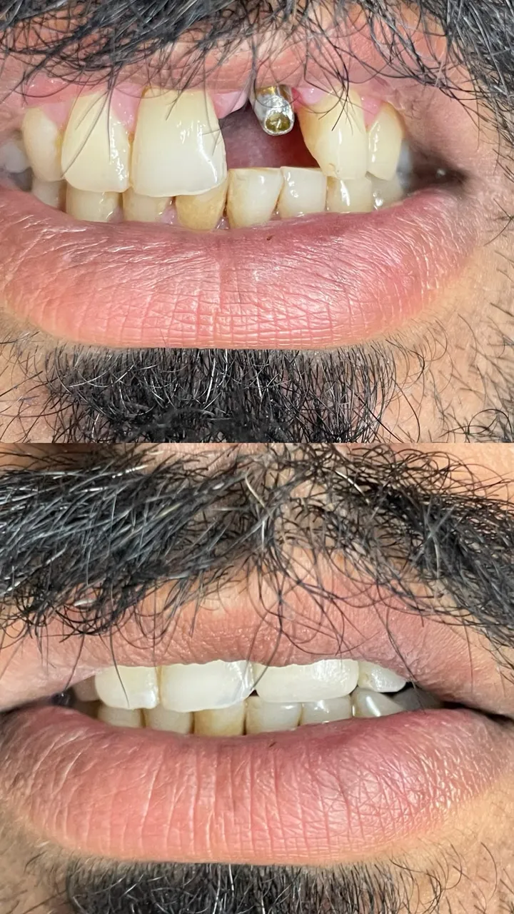 Missing front tooth restored with a dental implant — before and after