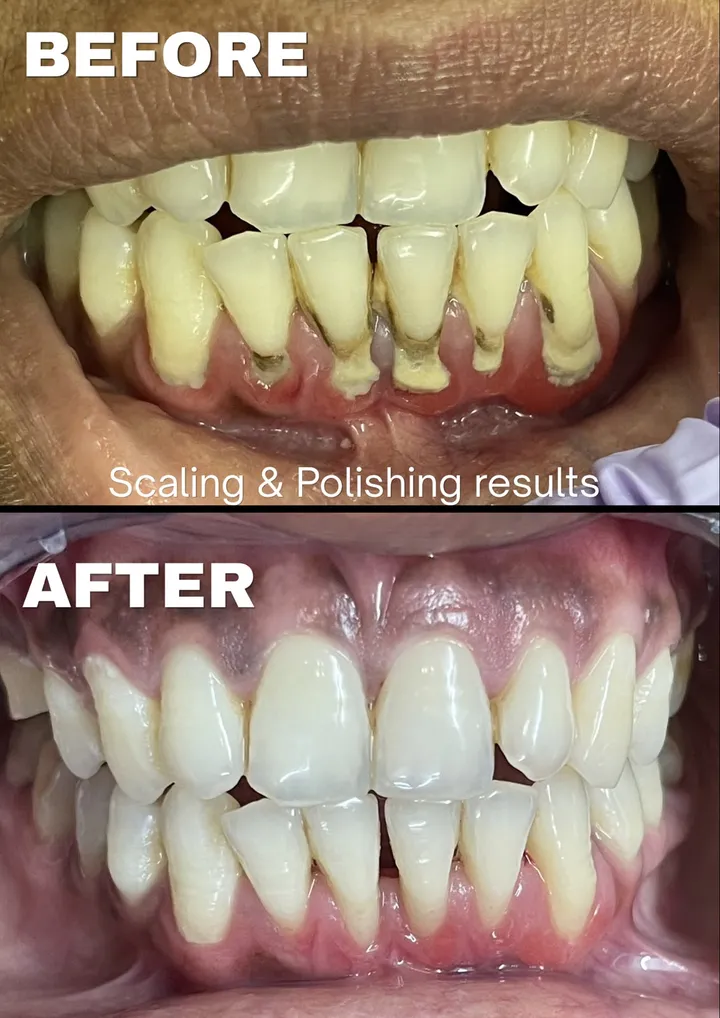 Scaling and polishing to remove stains and tartar — before and after